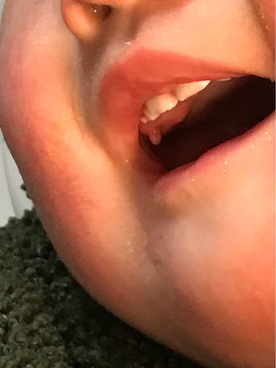 小孩牙肉上长牙齿图片图片