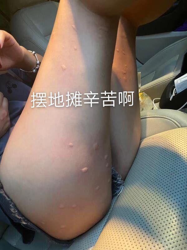 看看美女摆摊被蚊子咬成这个样子了,上海家化你就来个涨停吧